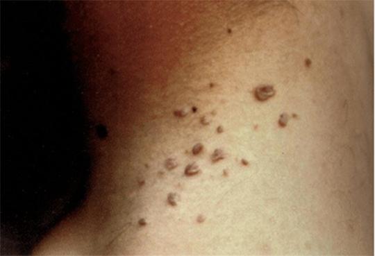 身上长小肉疙瘩有啥危害,身上长了小肉疙瘩能治愈吗