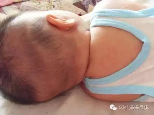 蚊子包止痒宝宝,怎么区分蚊子包和湿疹