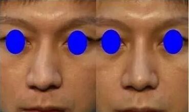 歪鼻子去哪里矫正,歪鼻子应该怎么办呢