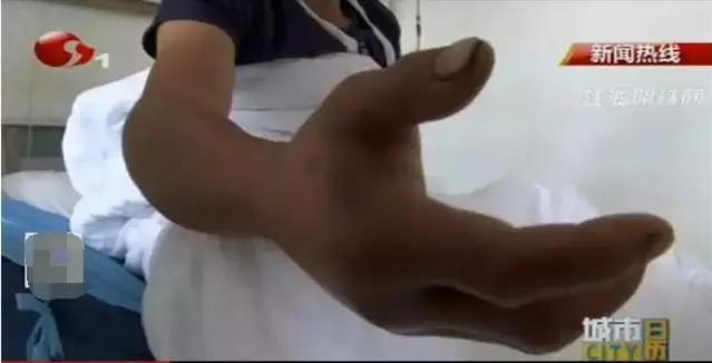 一男子被蝮蛇咬伤,一男子被剧毒蛇咬伤却没事