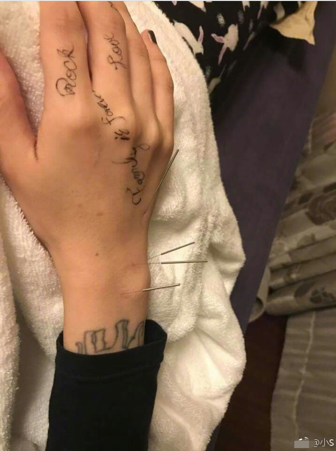 小S经过针灸2次已可慢步走路大赞中医博大精深