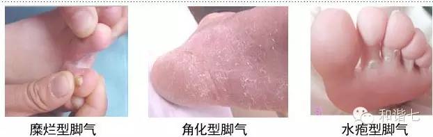 如何优雅抠脚,抠脚怎么说的优雅一点