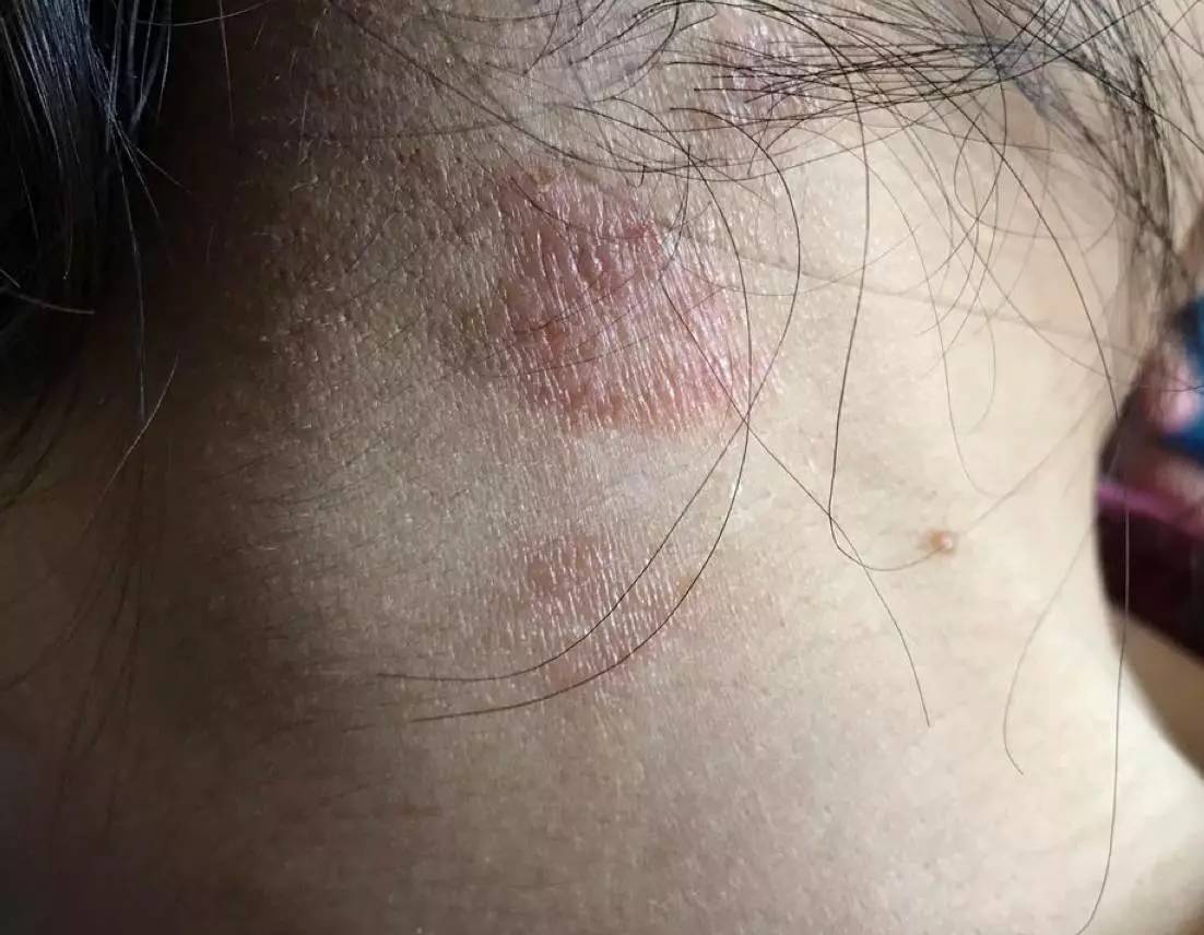 蚊子包止痒宝宝,怎么区分蚊子包和湿疹