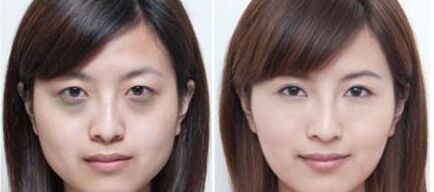 怎样快速有效的去除黑眼圈,小孩有黑眼圈怎么能快速去除