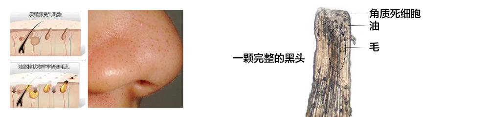 下巴有肉刺是什么病,下巴下面长很多小白点像白粉刺