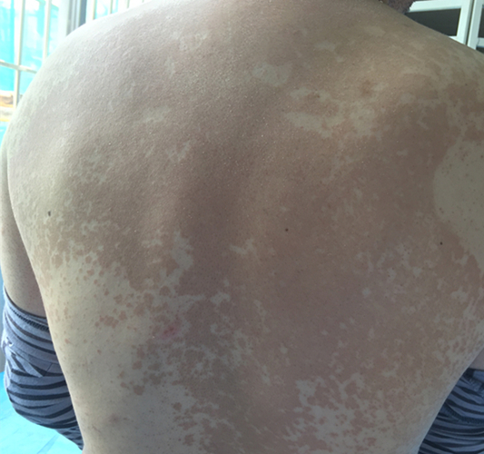 一到夏天就有白斑,一到夏天身上起红疙瘩有白头