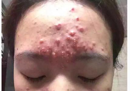什么是激素脸症状怎么治疗,什么叫做激素脸有哪些症状