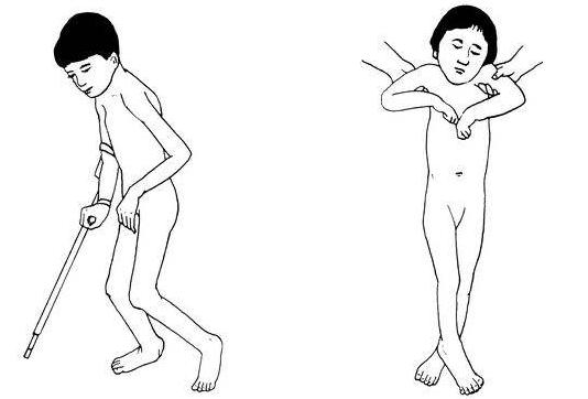 痉挛性脑瘫儿童的手部放松,痉挛性脑瘫儿童治疗过程远期目标