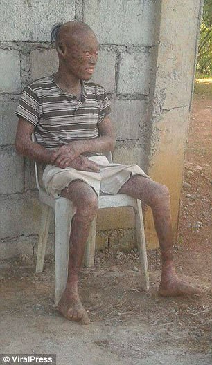 全身被烧伤后的皮肤,皮肤烧伤起皮疹