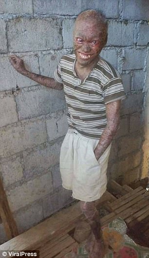 全身被烧伤后的皮肤,皮肤烧伤起皮疹