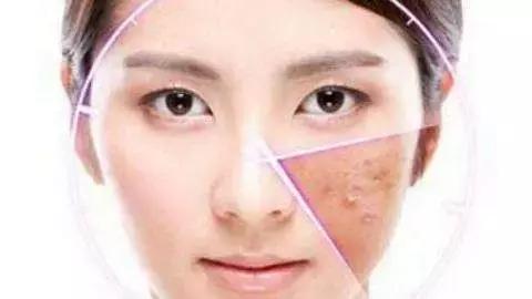 吃激素如何避免激素脸,美容院怎么避免激素脸