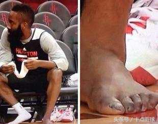 有回报必有付出，看看NBA超巨的手指脚趾，难以想象的痛苦程度