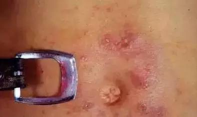 湿疹皮肤用药大全手册,湿疹性皮炎宣教