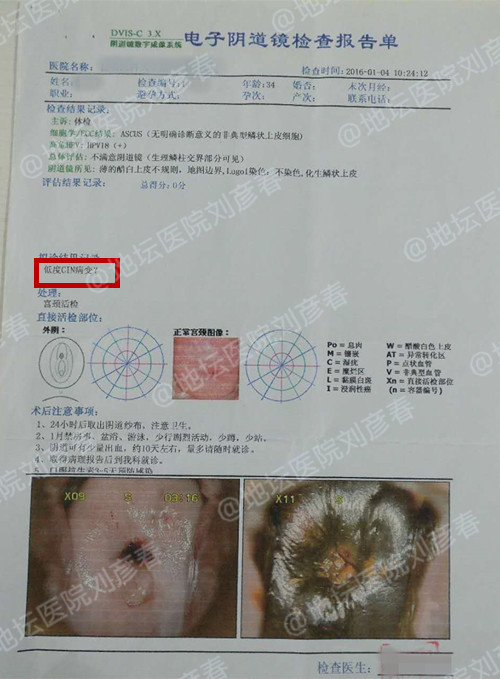 宫颈cin1级怎么做物理治疗,宫颈cin1级激光术后遗症