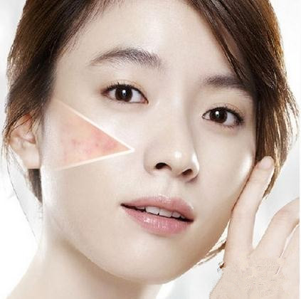 白醋洗脸可以有效去除脸上痘,白醋洗脸可以去除青春痘吗