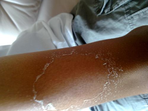 皮肤晒伤发红最快修复方法,皮肤晒黑了怎么变白