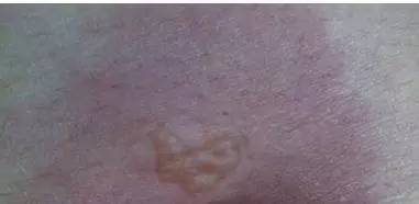 压疮久治不愈后果,身体压疮怎么治疗