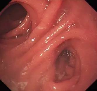 胃镜预处理流程,胃镜内镜手术全流程