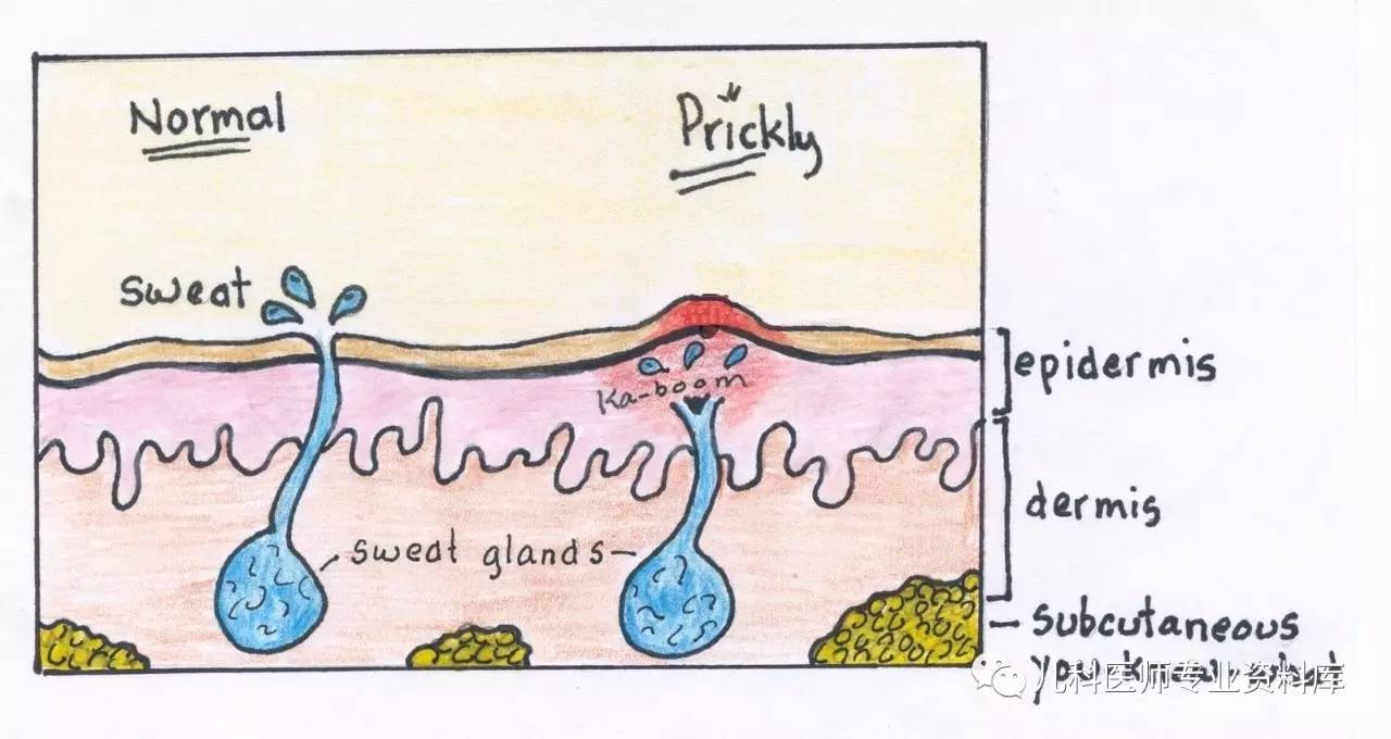 痱子疹子怎么治,大人痱子和热疹