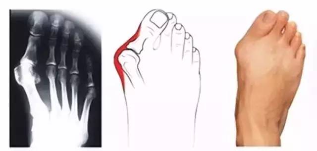 跑鞋导致拇外翻,拇外翻必须穿专门跑鞋跑步吗