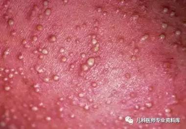 宝宝长痱子热疹,大人痱子和热疹