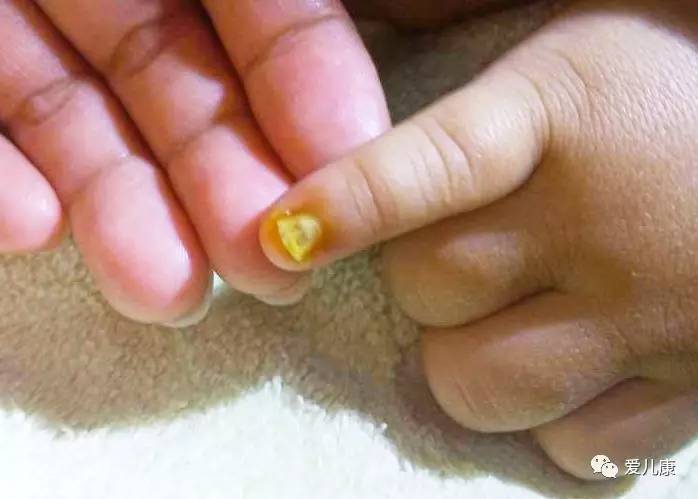 宝宝指甲分层脱落该怎么办,婴幼儿指甲出现空甲现象怎么办