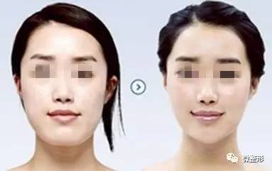 打一针水光针,打一针玻尿酸要1万多