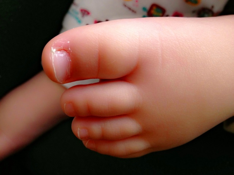 要怎么做才能让宝宝远离危险,宝宝为什么容易得甲沟炎