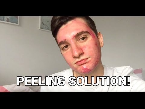 祛痘祛闭口粉刺黑头,如何有效的祛痘去黑头去闭口