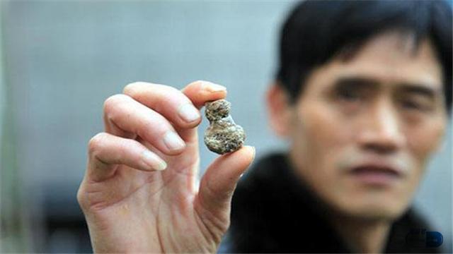 胆结石手术后需吃熊去胆酸胶囊吗,胆切除术后服熊去氧胆酸要服多久