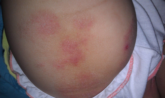 婴儿母乳过敏母亲怎么治疗,牛奶过敏的孩子如何母乳喂养