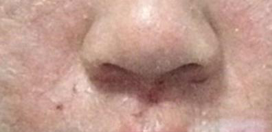 如何判断激素依赖性皮炎,怎样证明激素脸过了戒断期