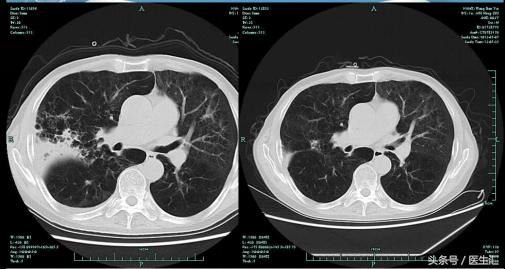 男性78岁慢性咳嗽气喘30余年,40岁男子持续咳嗽咳痰10多年