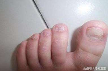 发现孩子指甲有问题日常建议,家长注意孩子手指甲