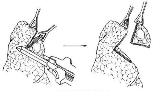 磨玻璃结节21mm穿刺还是直接切,双肺多发磨玻璃结节是什么意思