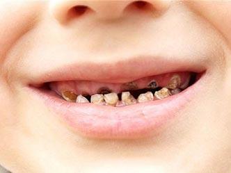 四岁宝宝里面两颗牙齿蛀虫了,三岁孩子牙齿蛀虫了怎么办