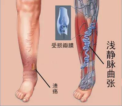 杏林中医院治静脉曲张吗,静脉曲张科普一下