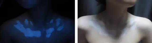 10岁女孩被妈妈查出白癜风,花季少女患白癜风真相