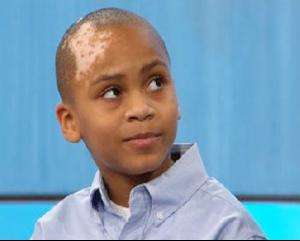 白癜风的人睡过的被子传染不,请问专家白癜风会传染吗