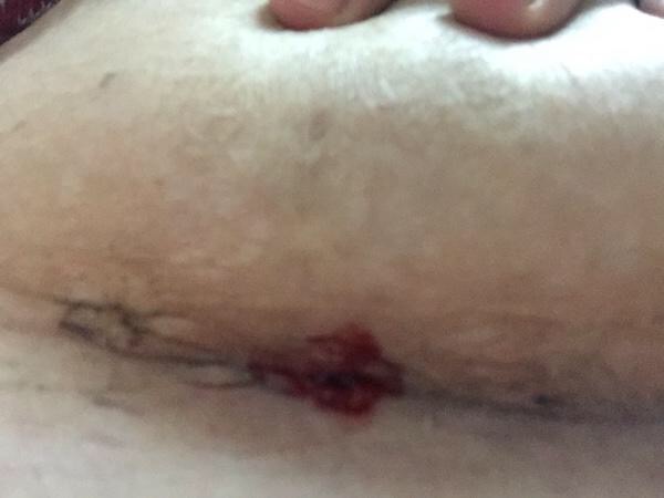 剖腹产伤口有个洞流脓不愈合,剖腹产伤口怎么缝合比较好