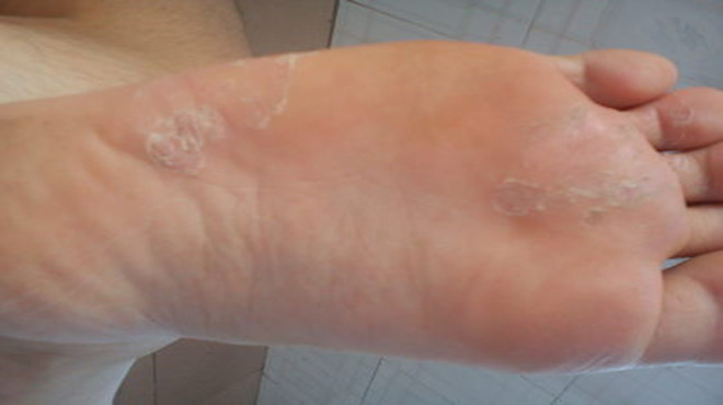 脚气小偏方藿香正气水能治脚气吗,脚气用什么妙招可以根除掉