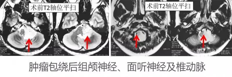 喝水容易呛是怎么回事是肺癌,老人喝水容易呛咳怎么办
