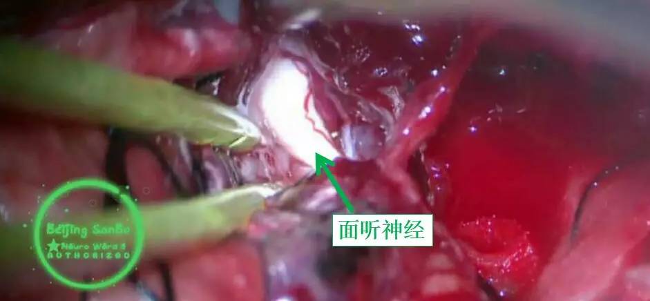 喝水容易呛是怎么回事是肺癌,老人喝水容易呛咳怎么办