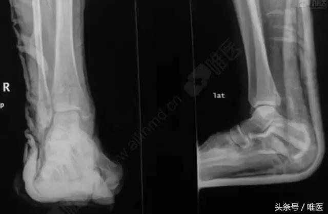 脚踝十年前扭伤现在肿痛什么原因,脚踝扭伤肿痛多少个小时可以擦药