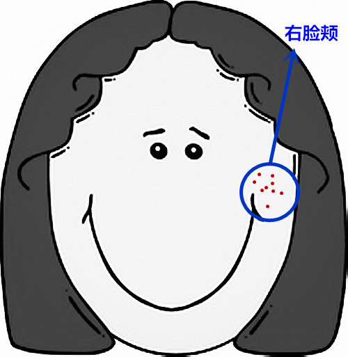 面部痘痘严重程度检测,痘痘面部分析