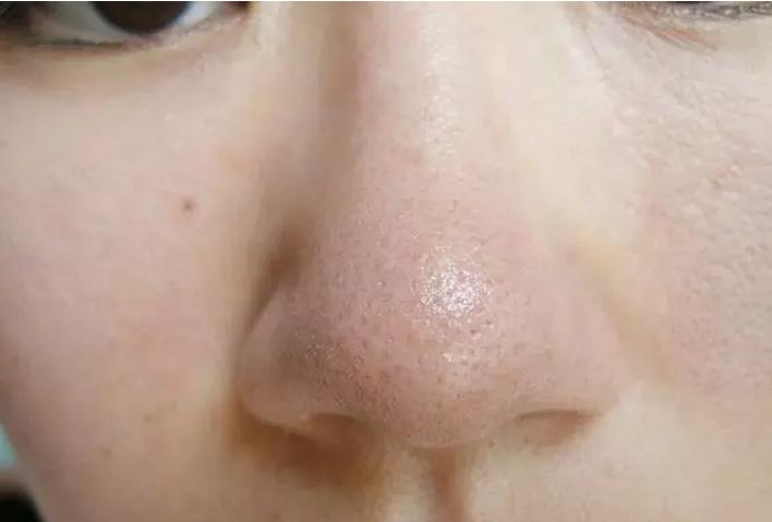 去黑头收缩毛孔的最好方法小妙招,实用去黑头收缩毛孔小妙招