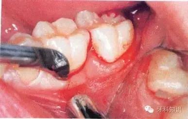 口腔拔牙图片,口腔拔牙麻醉多久消退
