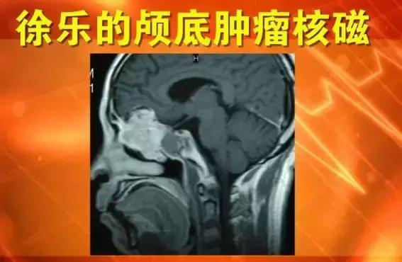 颅底恶性肿瘤原因,脑部肿瘤会导致鼻出血吗