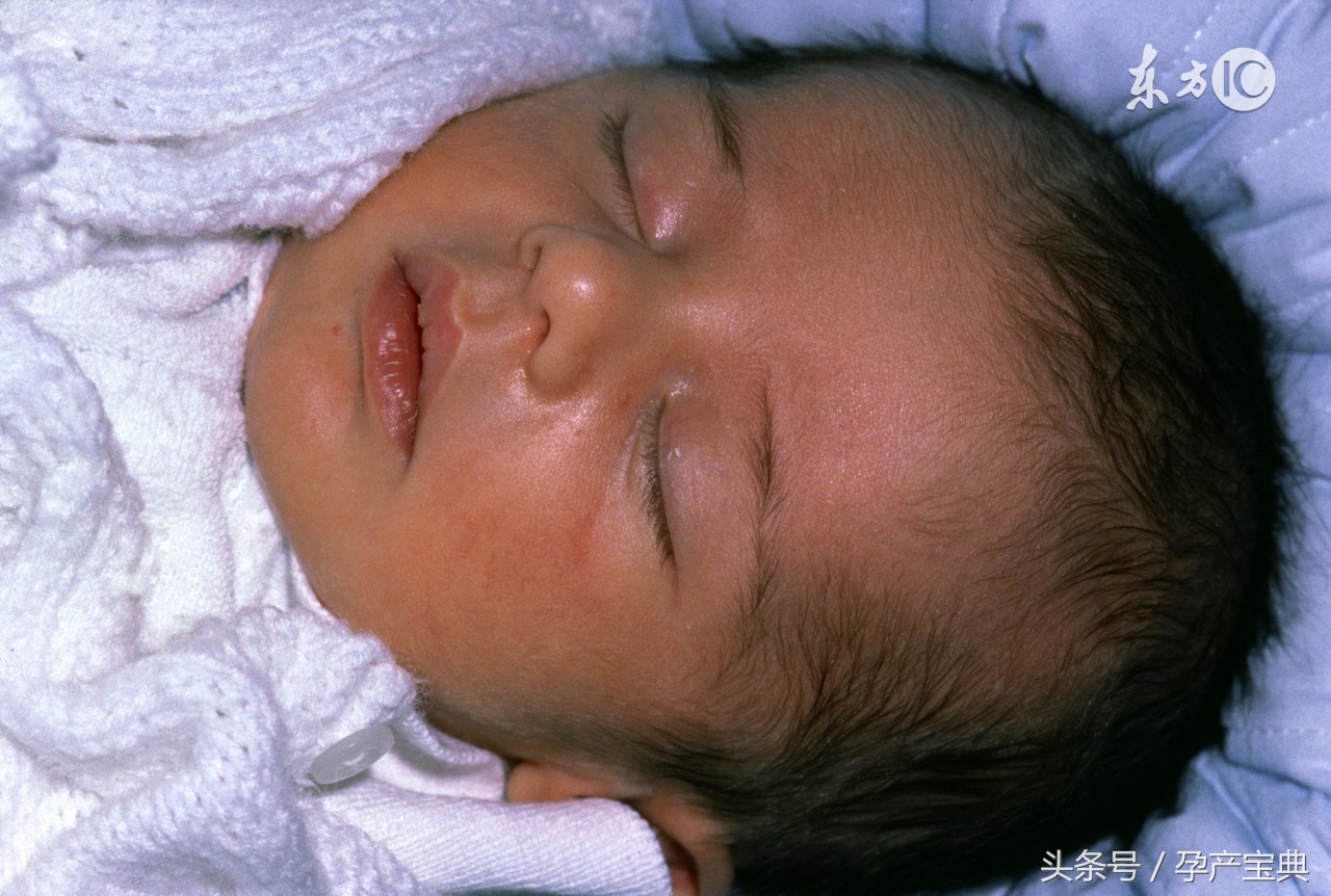 新生婴儿有黄疸又有湿疹怎么办,新生儿湿疹与黄疸有关系吗