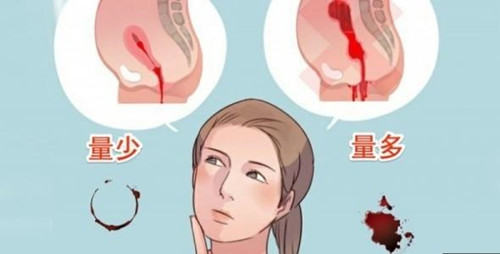 节育环真的万恶不赦吗,节育环放置不当会有哪些危害